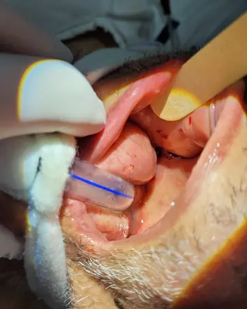 Boca de paciente intubado, com o tubo protegido por gaze