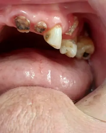 Dentes superiores com cáries extensas e restos radiculares