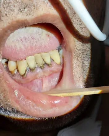 Dentes inferiores com cálculo acumulado junto à gengiva