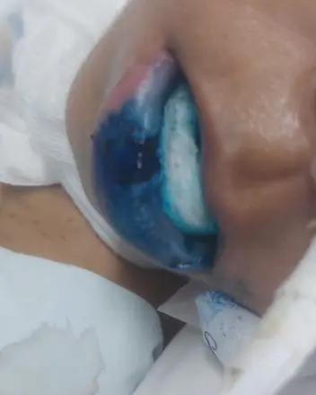 Lábios corados de azul durante o tratamento
