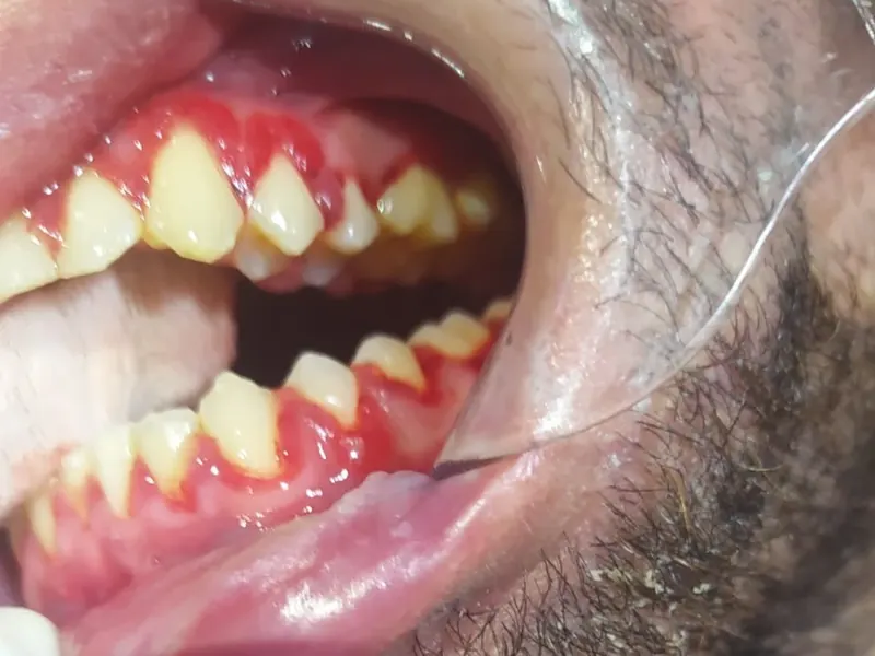Antes: gengiva vermelha, inchada e sangrando ao redor dos dentes