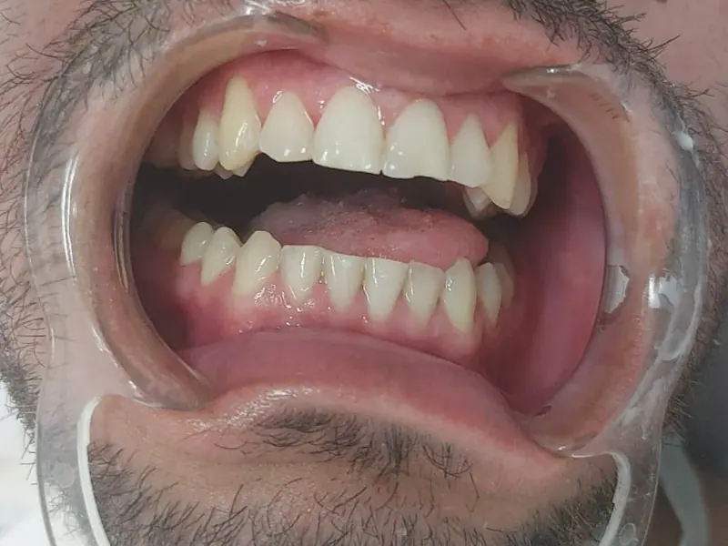 Depois: gengiva rosada e firme ao redor dos dentes, sem sangramento